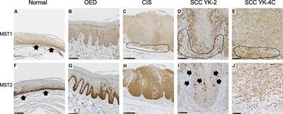 The significance of Hippo pathway protein expression in oral squamous cell carcinoma